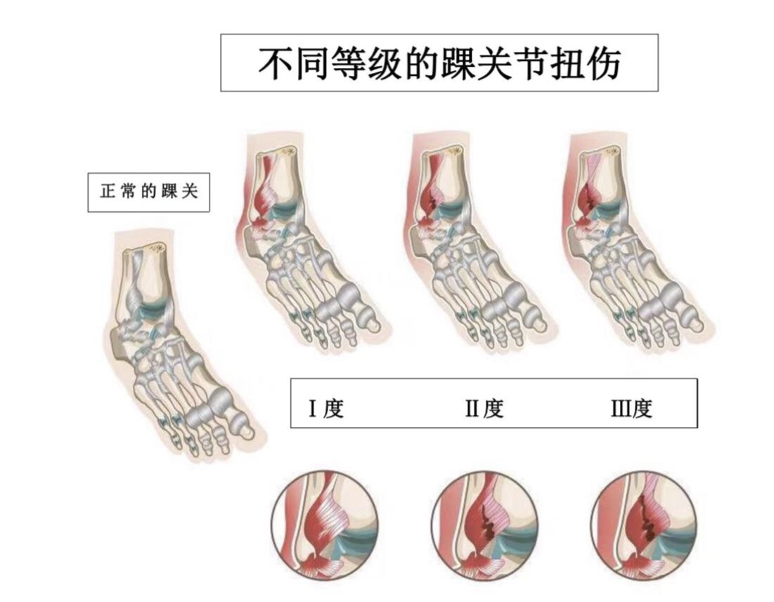 二级扭伤:踝关节的二级扭伤较一级扭伤来说会严重一些,一般发生该等级
