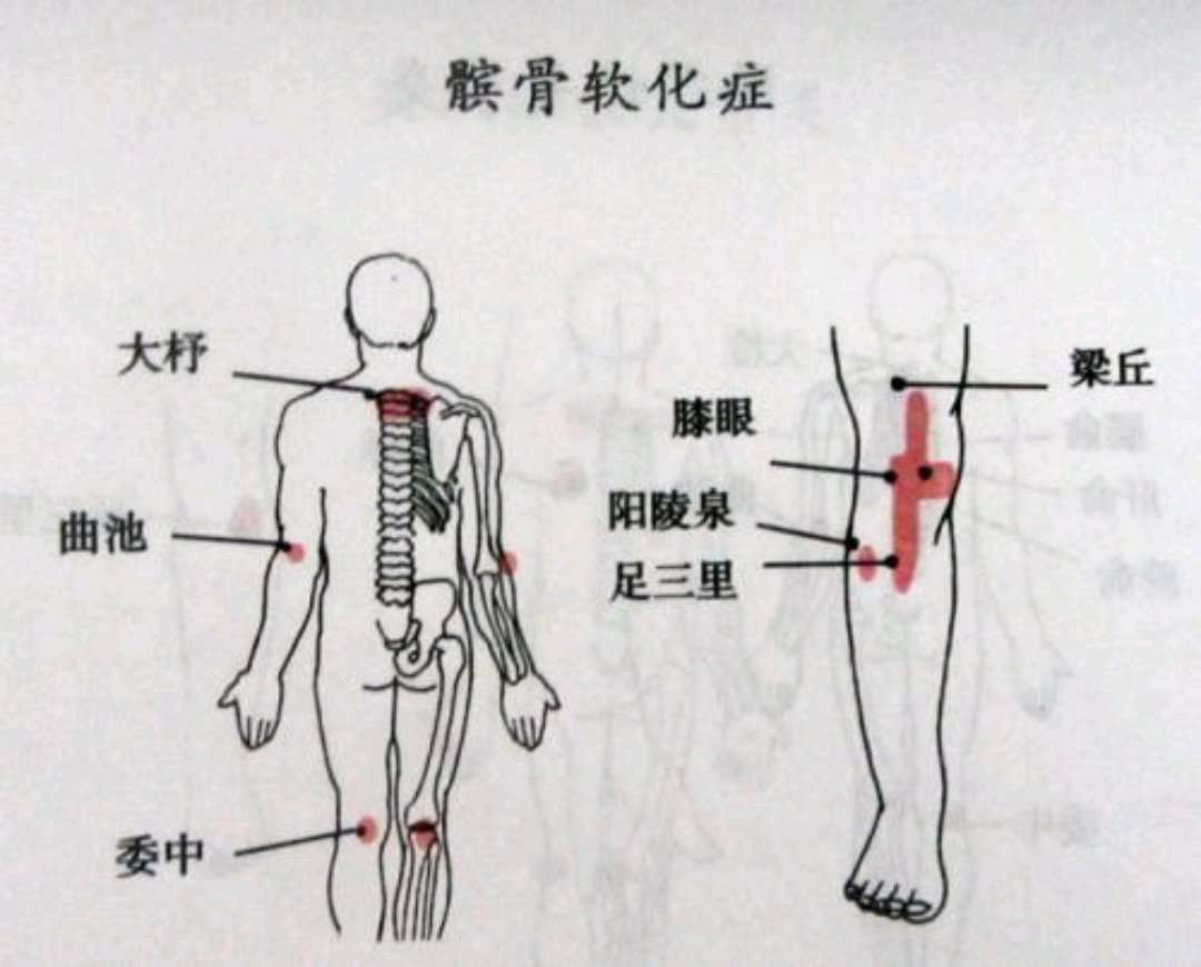 髌骨软化症的中医疗法