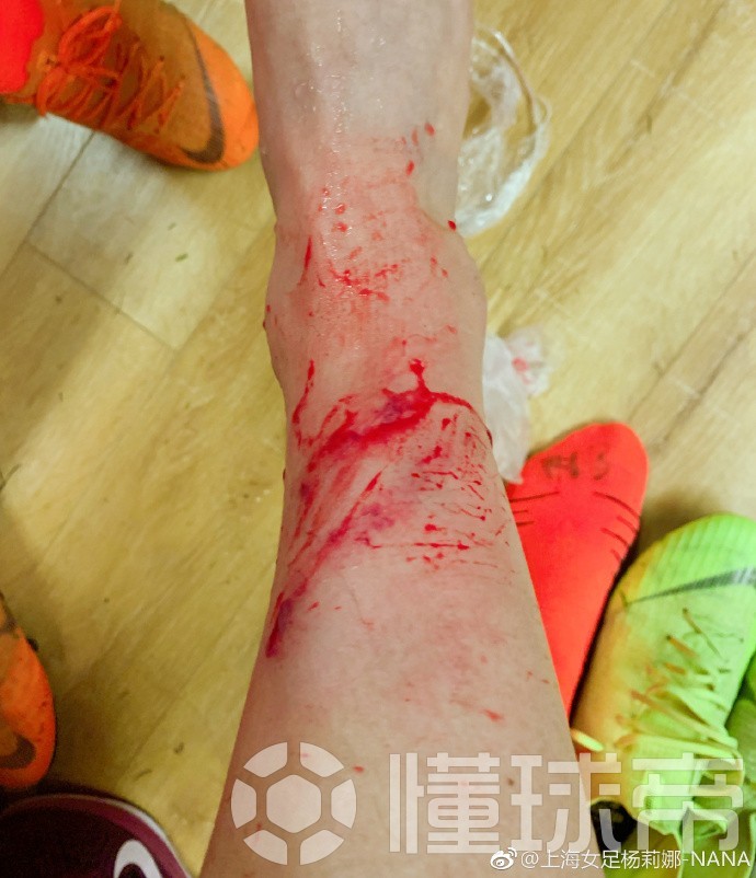 心疼,女足国脚杨莉娜腿部受伤血迹斑斑
