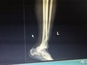 网传杨阔X光片：胫骨、腓骨下段开放性骨折
