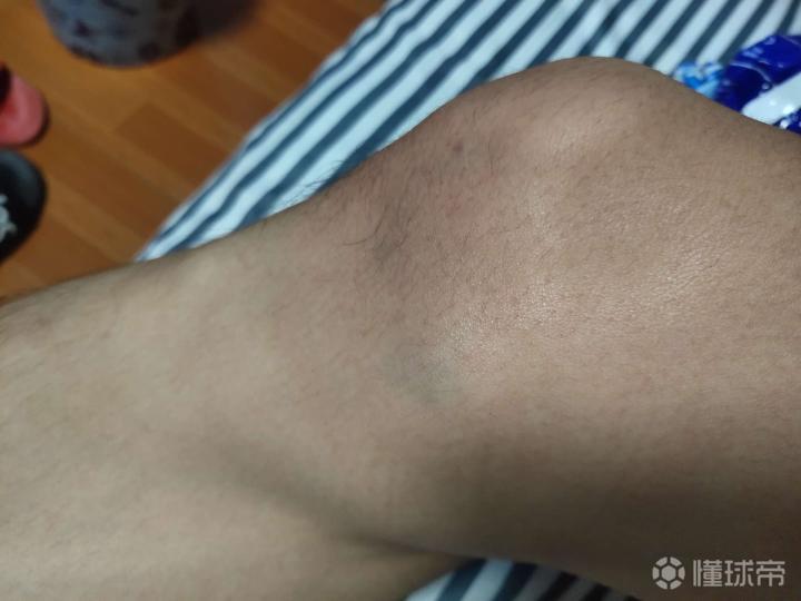 膝盖侧副性韧带拉伤多久能好啊,怎么恢复快