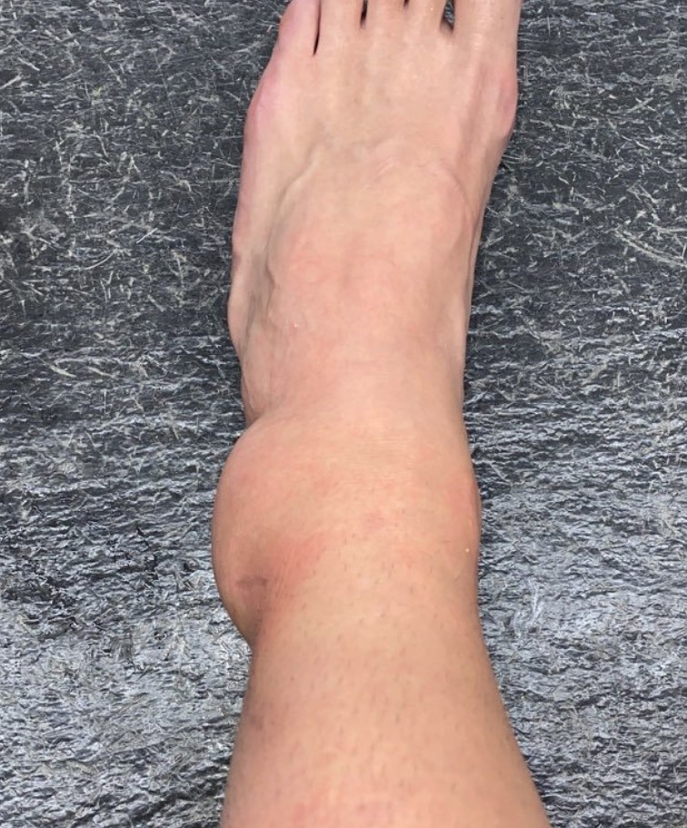 蚊虫叮咬导致脚踝肿胀图片