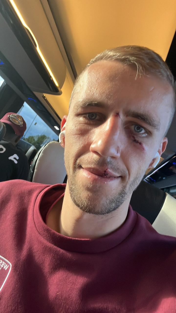 绍切克晒脸部受伤照:脸上又缝了几针,别担心,我还活着