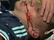 基米希在与瑞士球员争顶时被肘击、划伤面部，血流满面