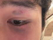 阮奇龙被击中面部：当时头晕呕吐，现在并无大碍