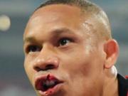 慎入！韦林顿-席尔瓦伤口特写：上嘴唇裂开一道深口子